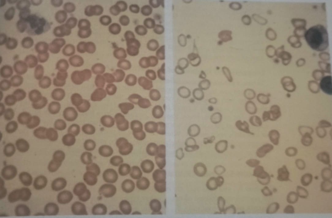 anemia in chronic disease icd10