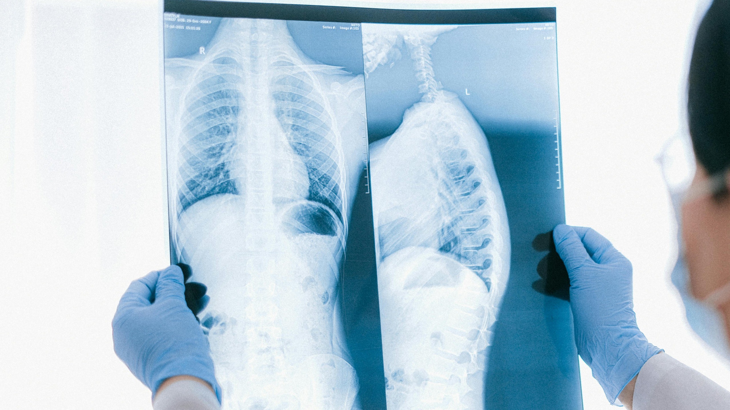 chronic obstructive pulmonary disease stages